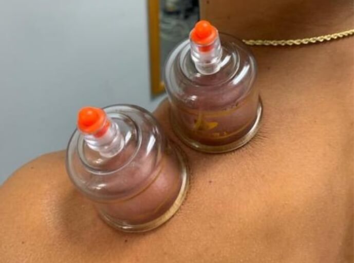 cupping-therapy-Physical Therapy Mililani Kailua