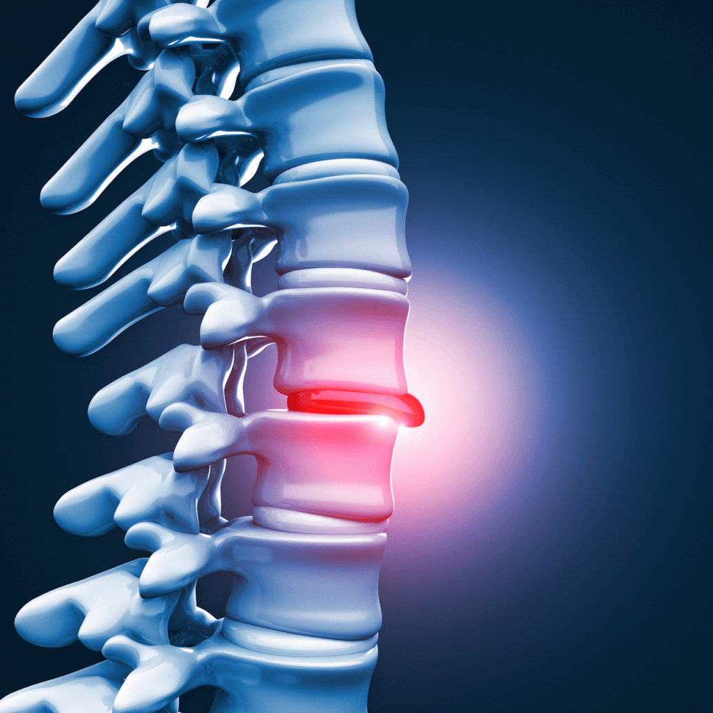 Should I See a Physical Therapist for Herniated Disc Pain?